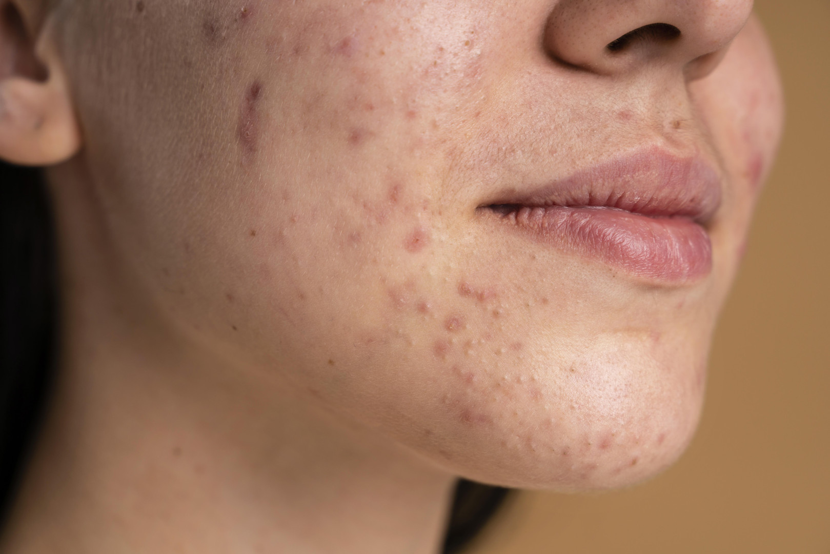 Close-up acne